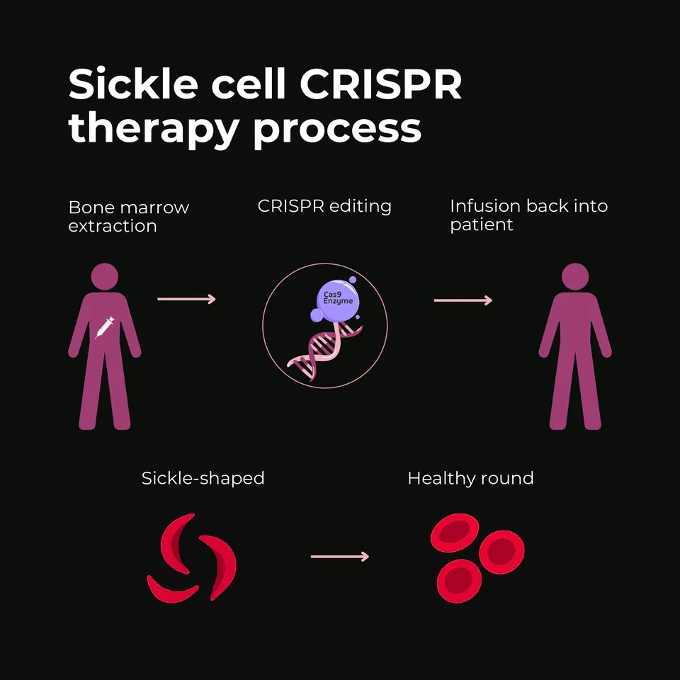 Sickle cell CRISPR therapy process: bone marrow extraction, CRISPR editing of the stem cells with the Cas9 enzyme, and infusion back into the patient, turning sickle-shaped red blood cells into healthy round ones